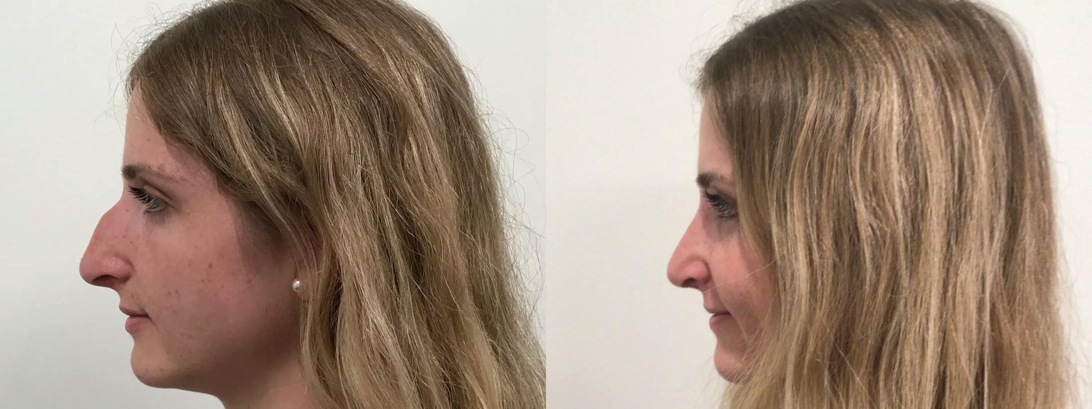 Rhinoplasty Before & After Gallery - Patient 411305 - Image 2