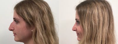 Rhinoplasty Before & After Gallery - Patient 411305 - Image 2