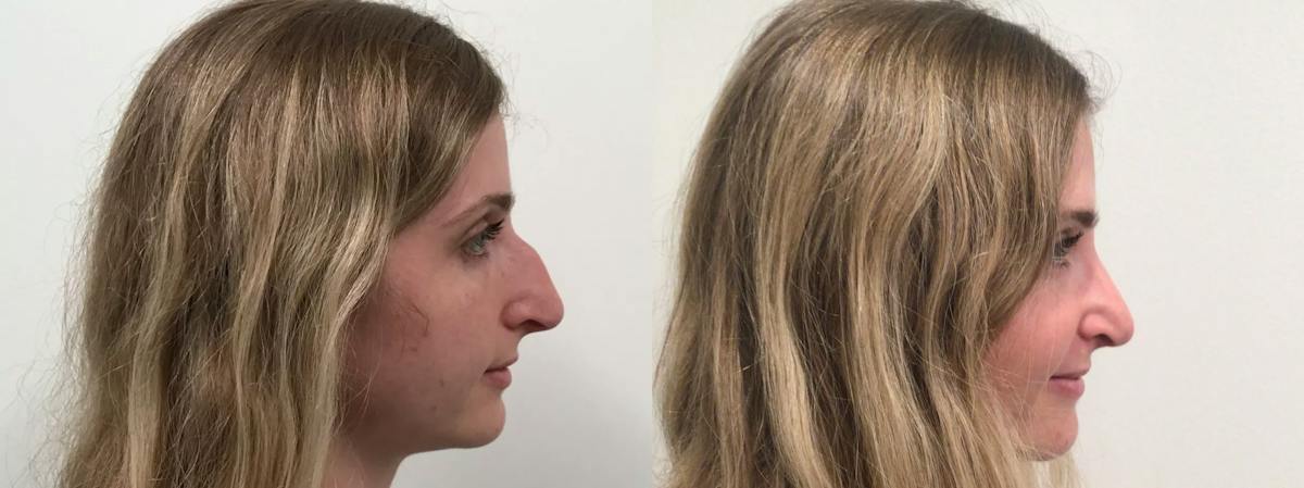 Rhinoplasty Before & After Gallery - Patient 411305 - Image 3