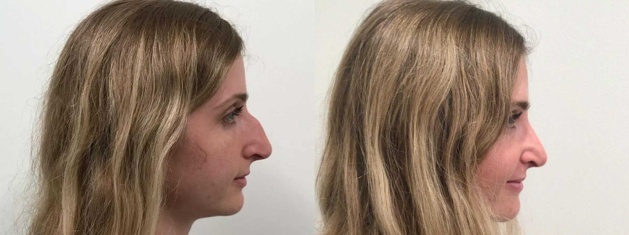 Rhinoplasty Before & After Gallery - Patient 411305 - Image 3