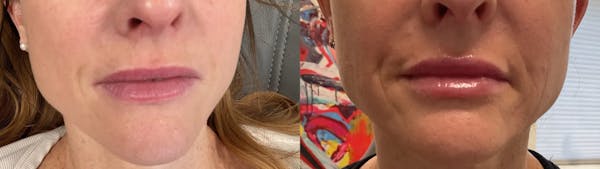 Lip Augmentation Before & After Gallery - Patient 256925 - Image 1