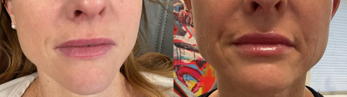 Lip Augmentation Before & After Gallery - Patient 256925 - Image 1