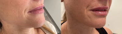 Lip Augmentation Before & After Gallery - Patient 256925 - Image 2