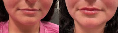 Lip Augmentation Before & After Gallery - Patient 363116 - Image 1