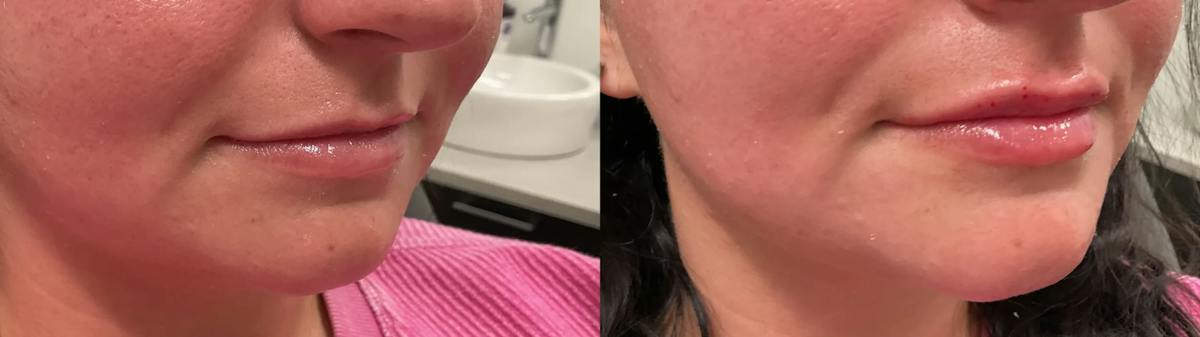 Lip Augmentation Before & After Gallery - Patient 363116 - Image 2