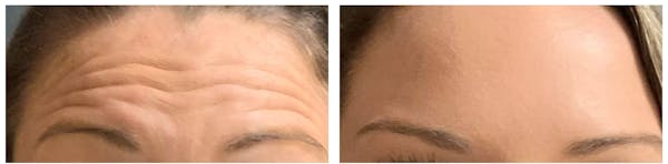 BOTOX® Cosmetic Before & After Gallery - Patient 769346 - Image 1