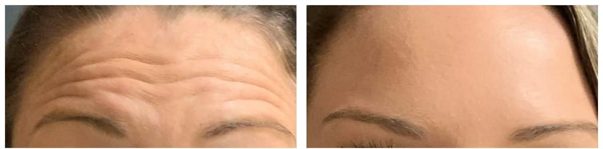 BOTOX® Cosmetic Before & After Gallery - Patient 769346 - Image 1
