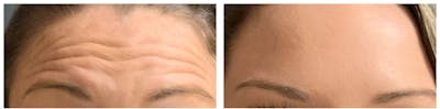 BOTOX® Cosmetic Before & After Gallery - Patient 769346 - Image 1