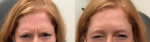 BOTOX® Cosmetic Before & After Gallery - Patient 339485 - Image 1