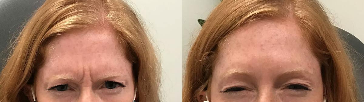 BOTOX® Cosmetic Before & After Gallery - Patient 339485 - Image 1