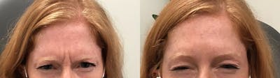 BOTOX® Cosmetic Before & After Gallery - Patient 339485 - Image 1