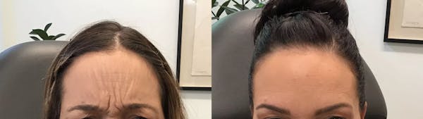 BOTOX® Cosmetic Before & After Gallery - Patient 401681 - Image 1