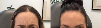 BOTOX® Cosmetic Before & After Gallery - Patient 401681 - Image 1