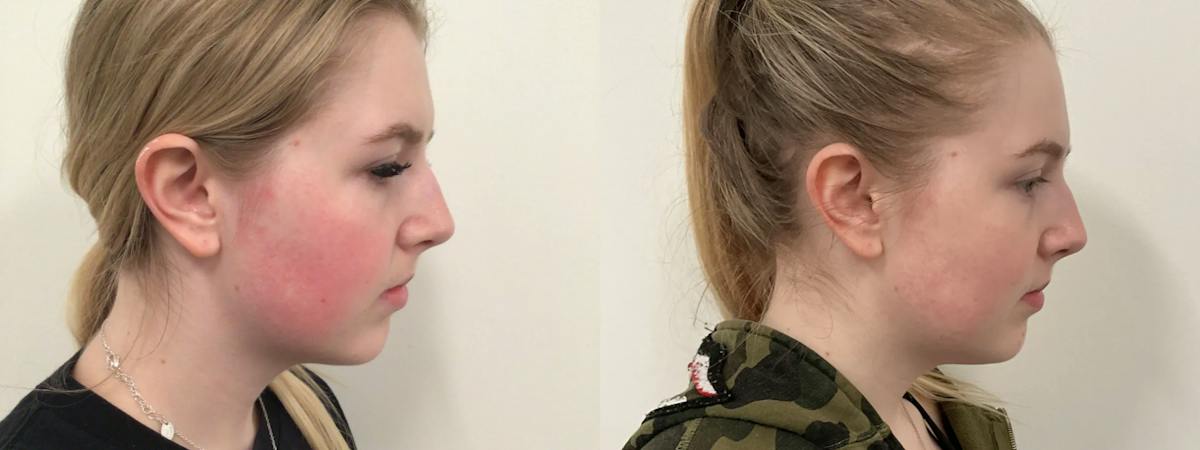 Icon Laser Before & After Gallery - Patient 387112 - Image 1