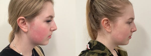 Icon Laser Before & After Gallery - Patient 387112 - Image 1