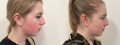 Icon Laser Before & After Gallery - Patient 387112 - Image 1