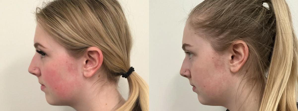 Icon Laser Before & After Gallery - Patient 387112 - Image 2
