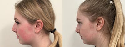 Icon Laser Before & After Gallery - Patient 387112 - Image 2