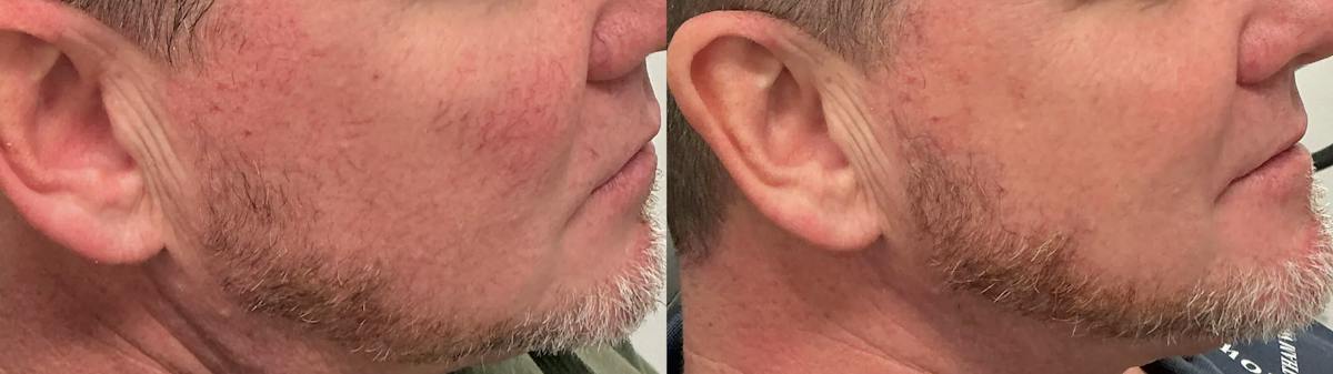 Icon Laser Before & After Gallery - Patient 170858 - Image 1