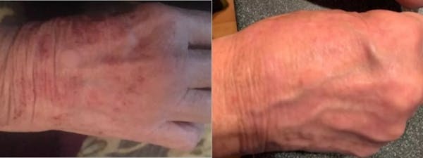 Icon Laser Before & After Gallery - Patient 263518 - Image 1