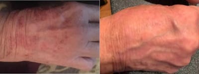 Icon Laser Before & After Gallery - Patient 263518 - Image 1