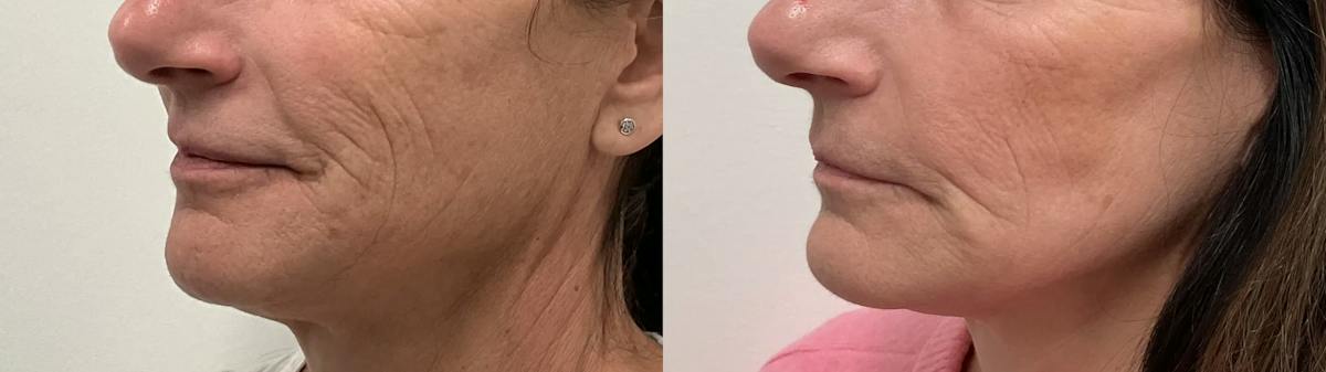 Helix CO2 Laser Before & After Gallery - Patient 257199 - Image 1