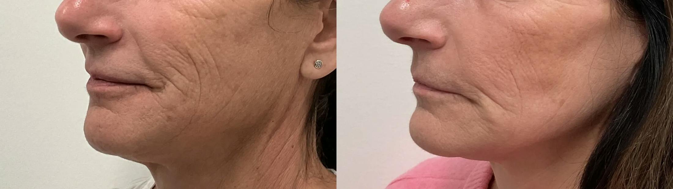 Helix CO2 Laser Before & After Gallery - Patient 257199 - Image 1
