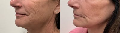 Helix CO2 Laser Before & After Gallery - Patient 257199 - Image 1