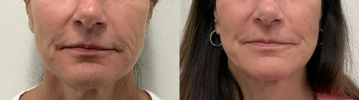 Helix CO2 Laser Before & After Gallery - Patient 257199 - Image 2