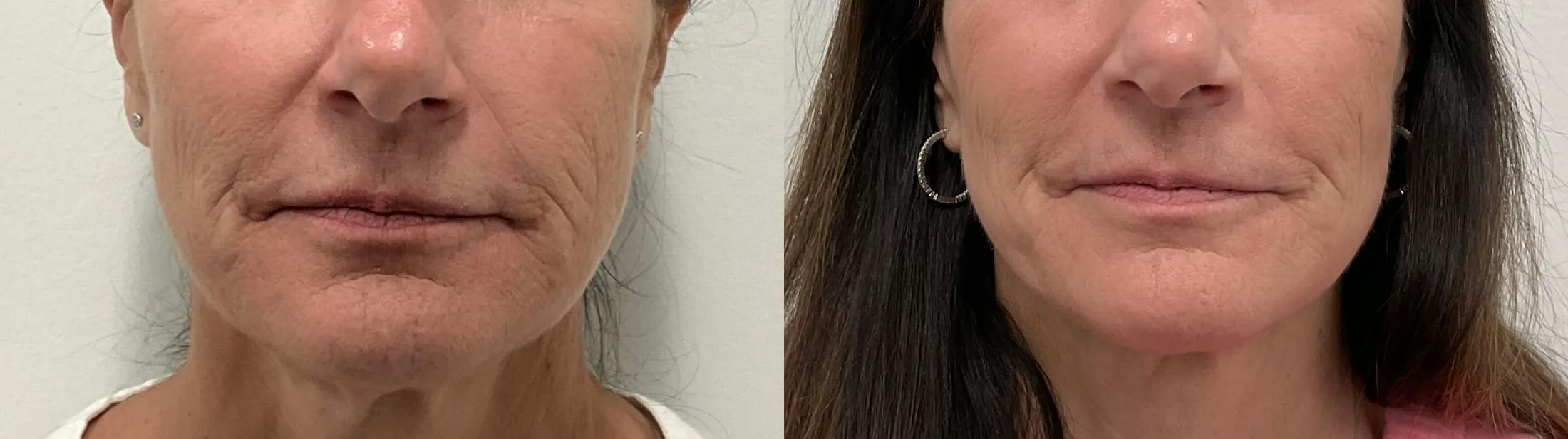 Helix CO2 Laser Before & After Gallery - Patient 257199 - Image 2