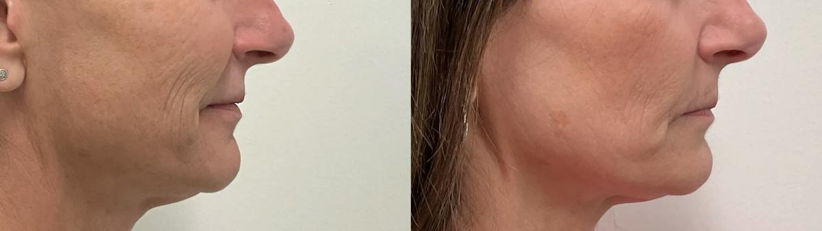 Helix CO2 Laser Before & After Gallery - Patient 257199 - Image 3