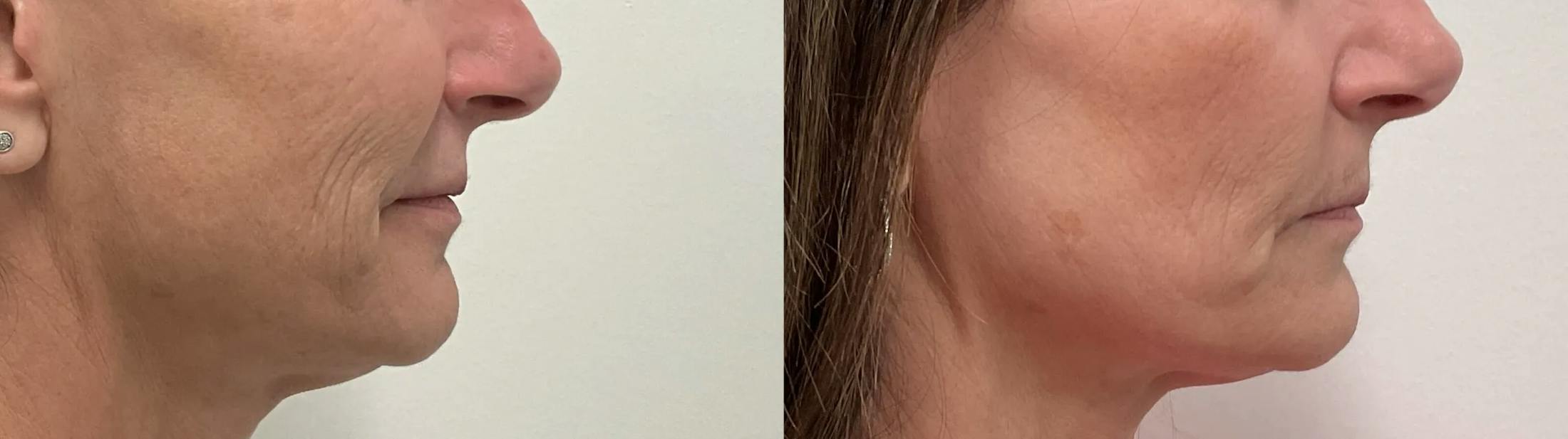 Helix CO2 Laser Before & After Gallery - Patient 257199 - Image 3