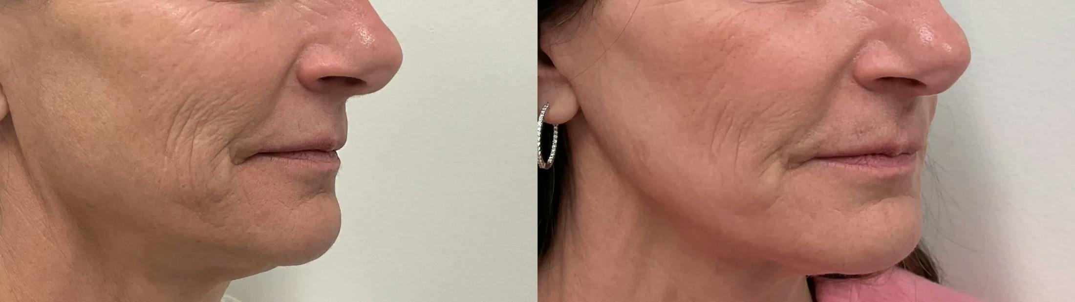 Helix CO2 Laser Before & After Gallery - Patient 257199 - Image 4