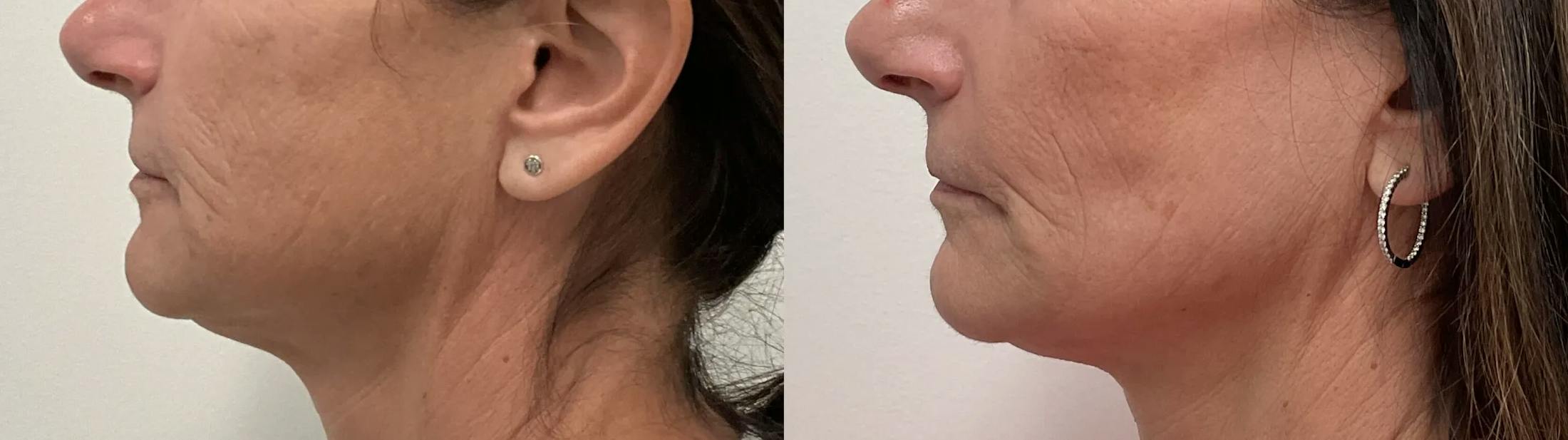 Helix CO2 Laser Before & After Gallery - Patient 257199 - Image 5