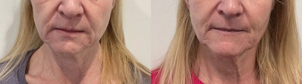 Helix CO2 Laser Before & After Gallery - Patient 255804 - Image 1