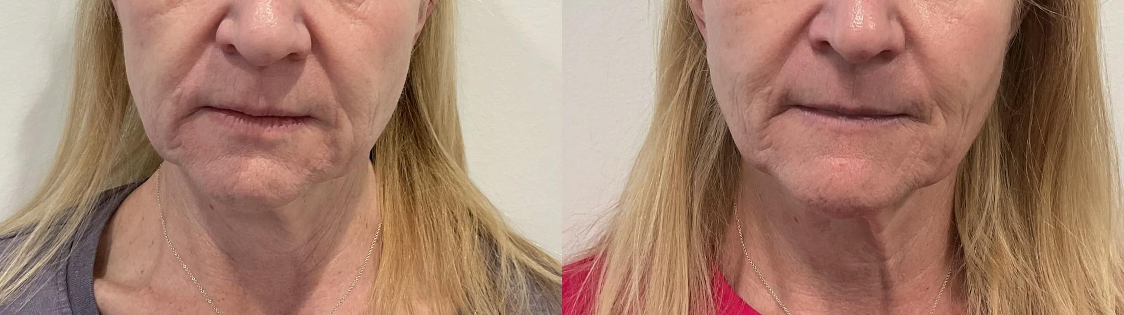 Helix CO2 Laser Before & After Gallery - Patient 255804 - Image 1