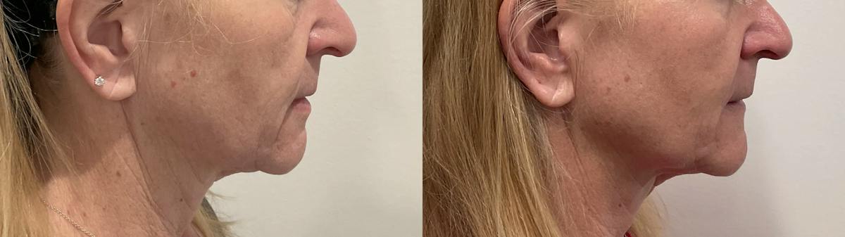 Helix CO2 Laser Before & After Gallery - Patient 255804 - Image 2