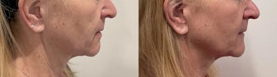 Helix CO2 Laser Before & After Gallery - Patient 255804 - Image 2