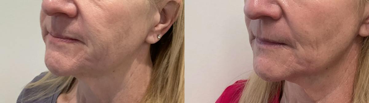 Helix CO2 Laser Before & After Gallery - Patient 255804 - Image 3