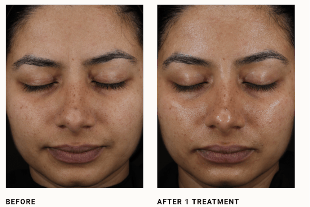 Before and After DiamondGlow Facial Manufacturer Image
