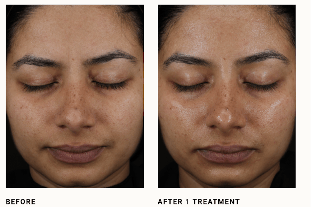 Before and After DiamondGlow Facial Manufacturer Image