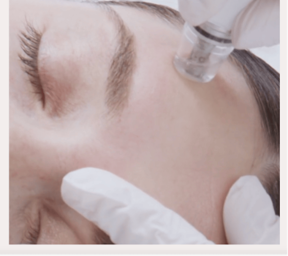 DiamondGlow Facial In Progress (Manufacturer Image)