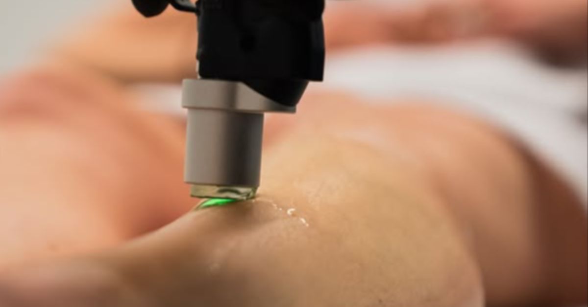 laser hair removal