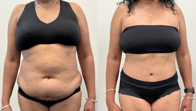 Tummy Tuck Before & After Gallery - Patient 339166 - Image 1