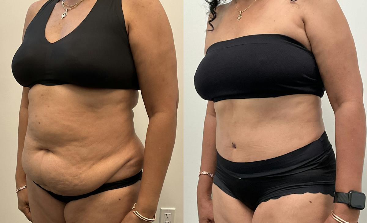 Tummy Tuck Before & After Gallery - Patient 339166 - Image 4