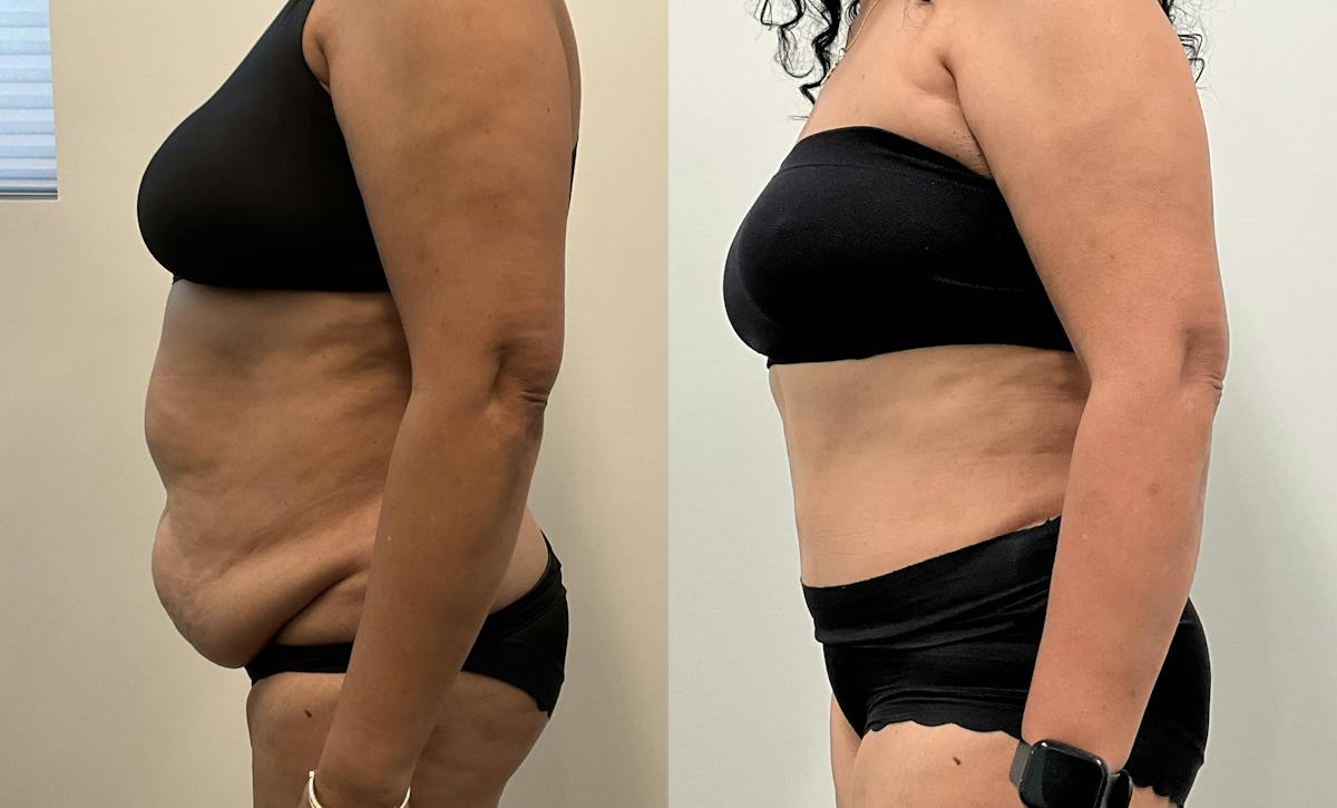 Tummy Tuck Before & After Gallery - Patient 339166 - Image 5