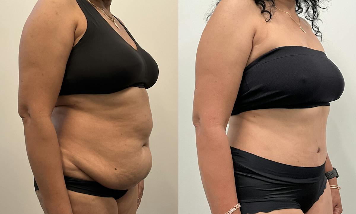 Tummy Tuck Before & After Gallery - Patient 339166 - Image 2