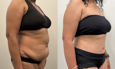 Tummy Tuck Before & After Gallery - Patient 339166 - Image 2