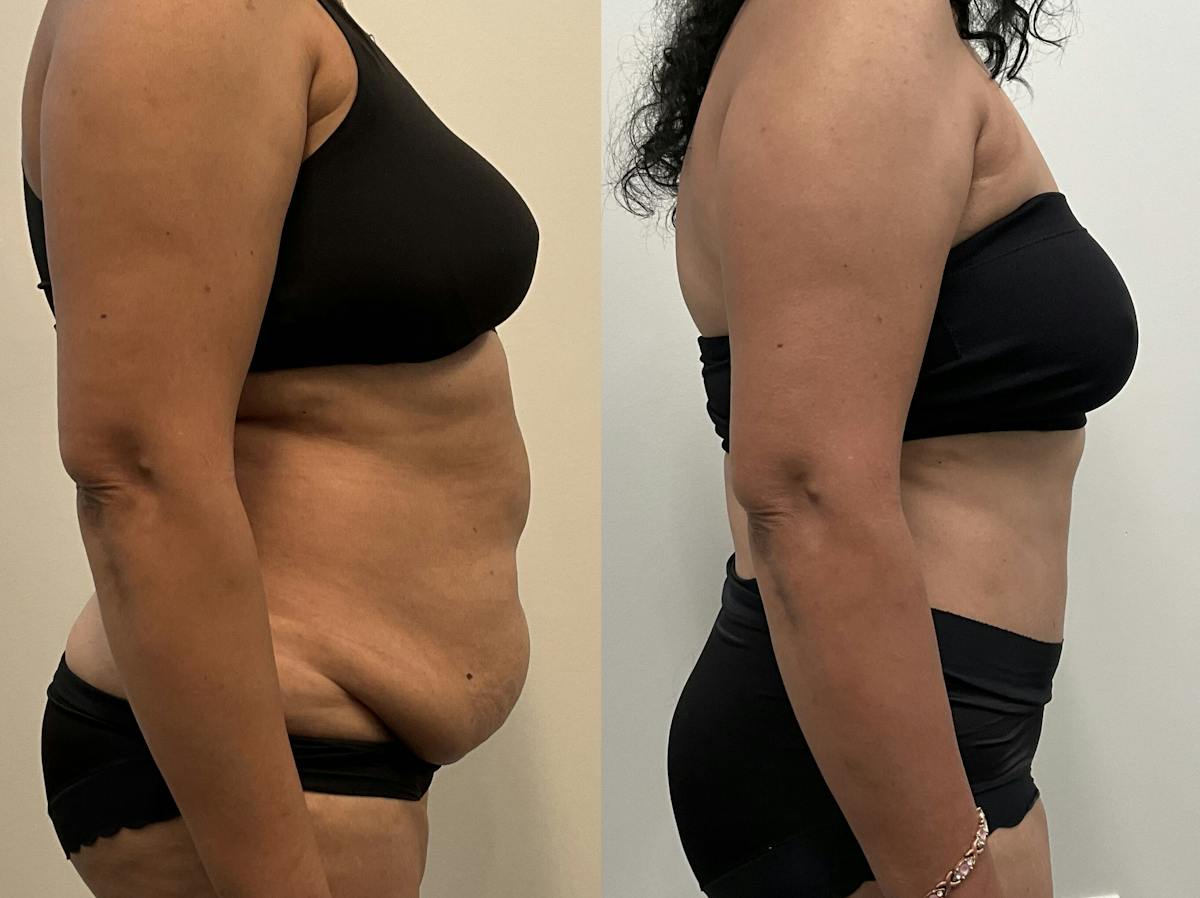 Tummy Tuck Before & After Gallery - Patient 339166 - Image 3