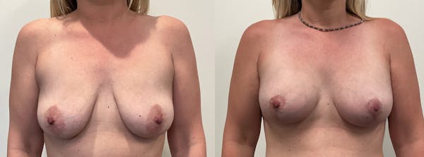 Breast Augmentation Before & After Gallery - Patient 136420 - Image 1